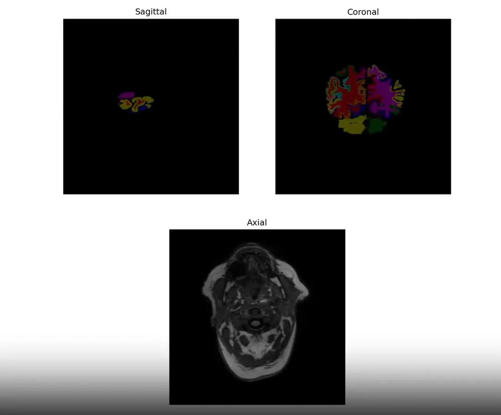 Brain MRI Segmentation, screen 1