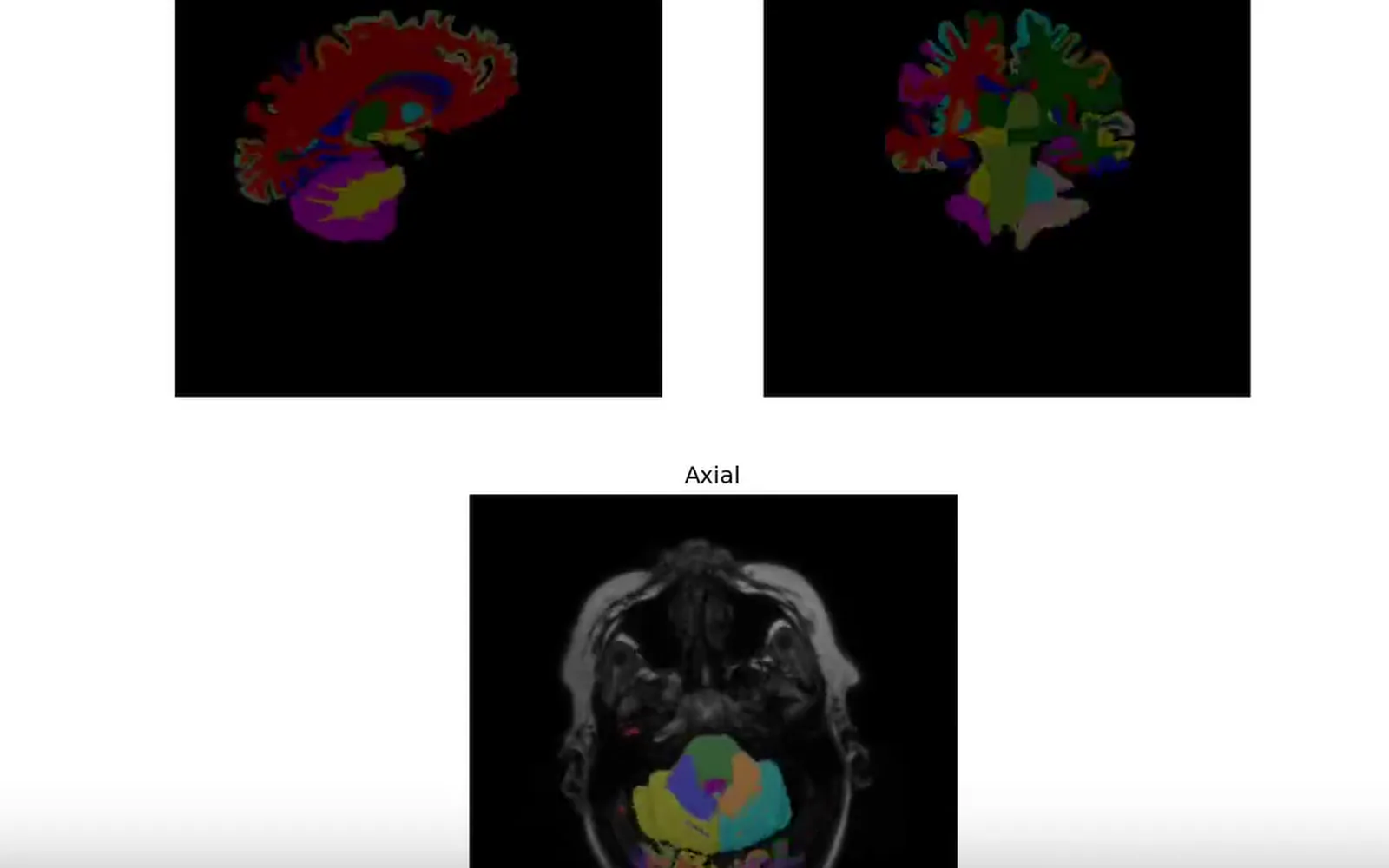 Brain MRI Segmentation: Segments structures in a brain MRI volume and renders the labelled regions across all three standard viewing planes.